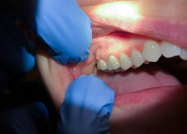 Best Emergency Treatment for Dental Infections or Abscesses in Waterford, CA